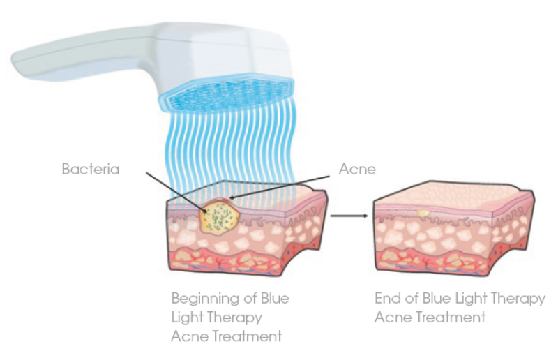FDA Approves Pulsaderm New Blue LED Skincare Product LEDinside